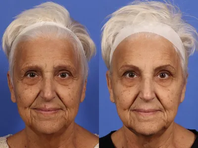 Botox Facial - ENT Aesthetics