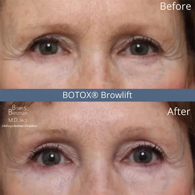 How Long Does Botox Take To Work? A Breakdown by Area