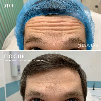 Как без операции/ с помощью ботокса поднять брови — vzbeauty.ru