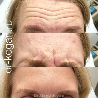 Ботокс лица до и после фото 84 фото