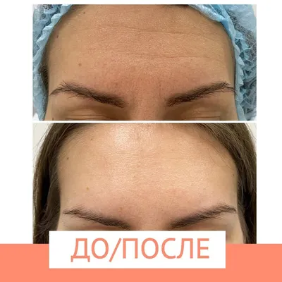 Ботокс для лица - цена в Санкт-Петербурге на инъекции и уколы Botox