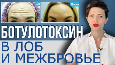 Ботокс инъекции - ботулинотерапия в Иваново | Прием врача косметолога