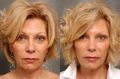 Ботокс от морщин: фото до и после, отзывы | Beauty Insider