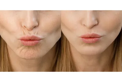 Кисетные морщины марионетки: как избавиться, убрать вокруг рта, над губой,  фото | Beauty Insider