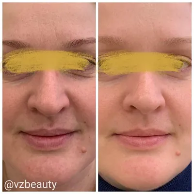 Необычный результат инъекций ботулотоксина (Ботокс) — vzbeauty.ru