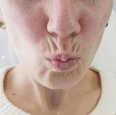 Кисетные морщины марионетки: как избавиться, убрать вокруг рта, над губой,  фото | Beauty Insider