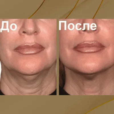 Инъекции ботокса от морщин вокруг губ в Москве — БИОМЕД