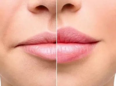 Отек губ после увеличения (аугментации) гиалуроновой кислотой | Клиника  \"Отражение\"