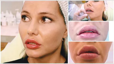 Ботокс до и после, фото губ после уколов Botox