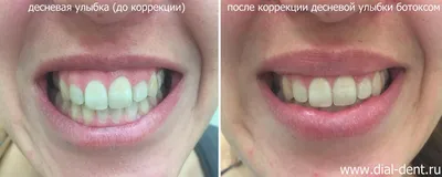 Увеличение губ: гайд года - Coolaser Clinic