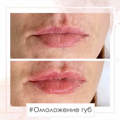 Необычный результат инъекций ботулотоксина (Ботокс) — vzbeauty.ru