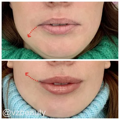 Поднять уголки рта. Ботокс — vzbeauty.ru