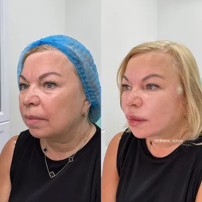 Ботокс Фулл фейс (full face) — что это такое и какие результаты можно  получить — vzbeauty.ru