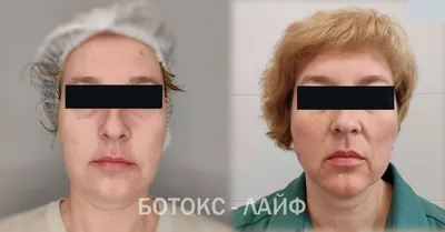 Ботокс - Клиника Максима Рослякова