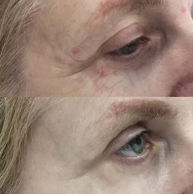 Фото до и после инъекционной косметологии и уход