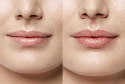 Увеличение губ до и после | Ботокс губы, Губы, Увеличение губ