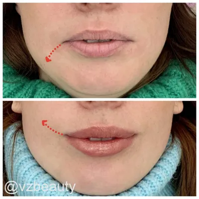 Ботокс губ: фото до и после, отзывы специалистов, как проходит процедура
