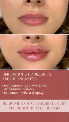 Поднять уголки рта. Ботокс — vzbeauty.ru