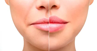 Увеличение губ ботокс косметолог в Щелково | Услуги | Авито