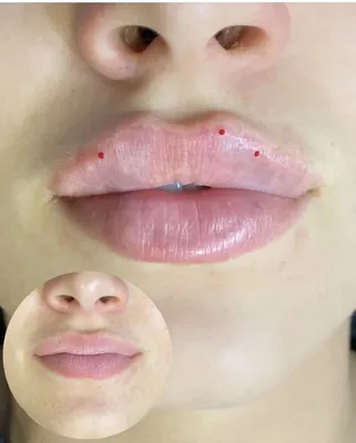 Процедура по увеличения губ техники и результаты. Фото - Косметология  доктора Корчагиной