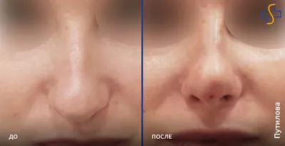 Коррекция формы носа филлерами: цена от 4990 рублей в Москве |  Безоперационная ринопластика в клинике BeautyWay Clinic