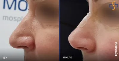 Как сузить широкий нос: инъекции или пластика? - Cosmetic-clinic