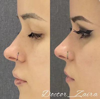 Коррекция носа ботоксом - Эпимед
