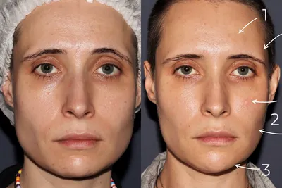 Ботокс Фулл фейс (full face) — что это такое и какие результаты можно  получить — vzbeauty.ru