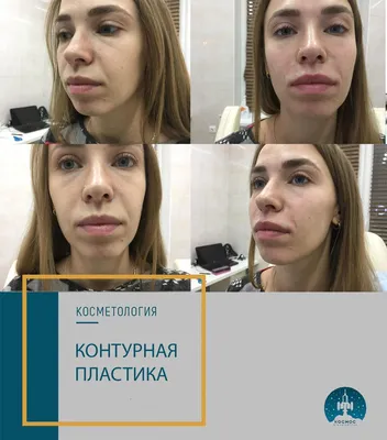 Ботокс (Botox) в носогубные складки в Санкт-Петербурге