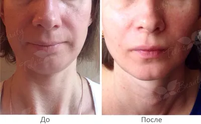 Что убирает носогубные складки? - Cosmetic-clinic