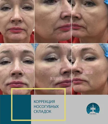 Ботокс для лица - цена в Санкт-Петербурге на инъекции и уколы Botox