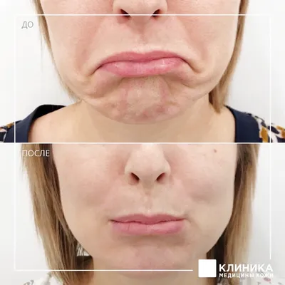 Поднять уголки рта. Ботокс — vzbeauty.ru