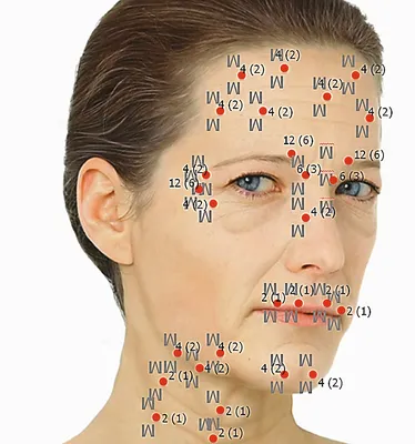 Сколько единиц Ботокса нужно на лоб, межбровье, вокруг глаз, губы и  носогубные складки | Клиника \"Отражение\"