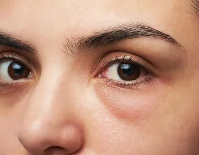 Ботокс вокруг глаз - Ботокс в область вокруг глаз, вводится для того, чтобы  разгладить «гусиные лапки». На фото не окончательный результат… | Instagram