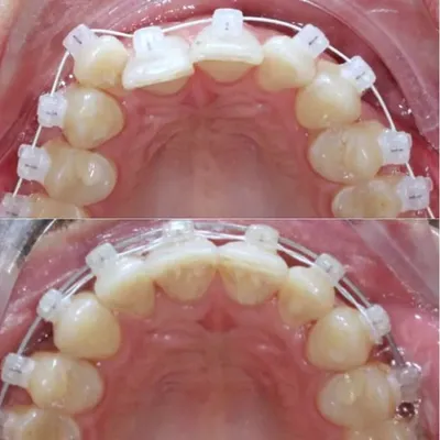 Лечение брекетами Damon clear - блог стоматолога TopSmile