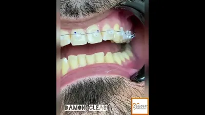 Ортодонтическое лечение самолигирующими брекетами Damon clear | Работы  врачей стоматологии Зубренок