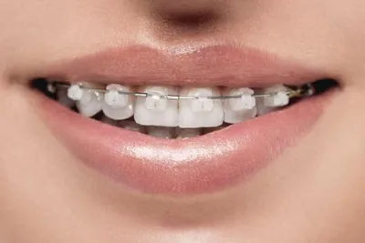 О стоматологии и не только...: Брекеты Damon (Брекеты Даймон)
