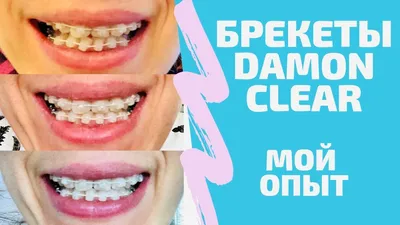 Брекеты Damon Q цена в Москве, стоимость брекетов Дамон Clear, 3 | ортодонт  Белорусская