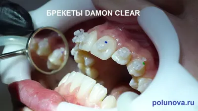 Девочка стеснялась улыбаться / исправление прикуса на комбинированной брекет-системе  Damon Clear, Damon Q / :: NORD DENTAL — семейная стоматология. Две клиники  на севере Петербурга
