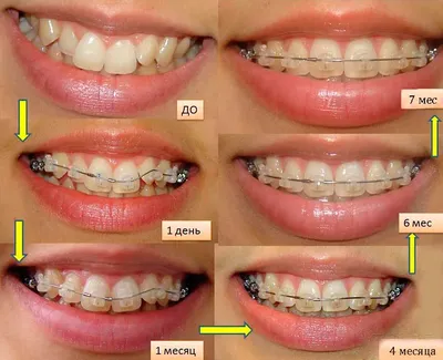 Установка керамических и металлических брекетов под ключ недорого