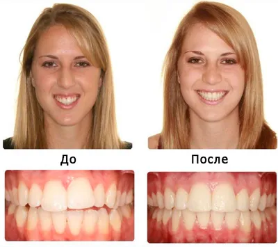 Брекеты. Срок ношения - Центр ортодонтии №1