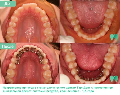 Установка брекет система по лучшей цене в СПб - Стоматология ТариДент