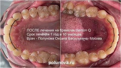 ЧТО ВАС ЖДЕТ В ХОДЕ ЛЕЧЕНИЯ НА БРЕКЕТ-СИСТЕМЕ | Барракуда, ортодонтический  центр, г. Ижевск