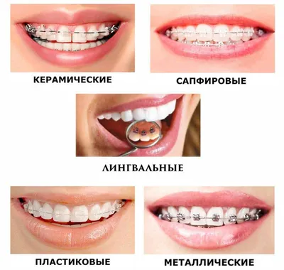 Лингвальные внутренние брекеты в Москве - цена и отзывы