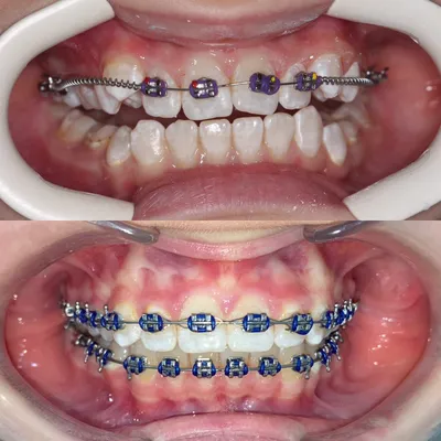 Фото до и после лечения у врача стоматолога-ортодонта Курдас С. С.