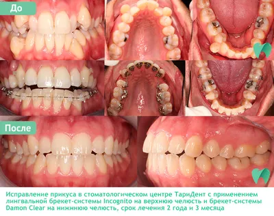 Фотографии до и после лечения зубов в Стоматологии ТариДент