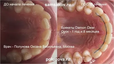 Брекеты на зубы – ставить или нет? Ответы на самые распространенные вопросы.