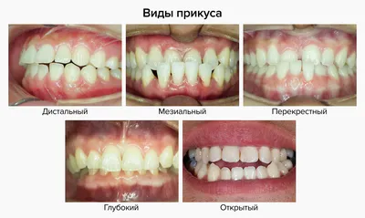 Брекет-системы | Стоматология в Запорожье Dental Studio