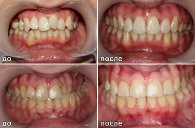 Исправление прикуса, установка брекетов - Центр имплантации и стоматологии  СмайлДент в Красноярске