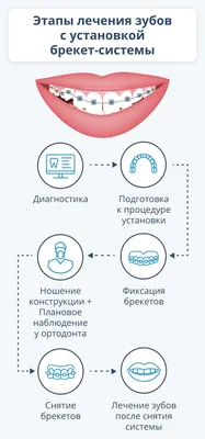 Результат исправления скрученности зубов металлическими брекетами, фото до  и после Москва